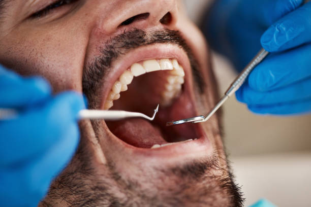 Best Knocked-Out Tooth (Avulsed Tooth) Treatment in Sebring, FL